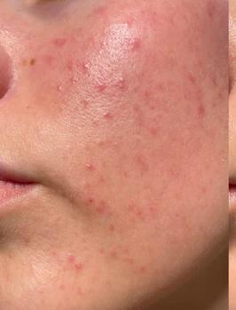 Before - Skin Texture