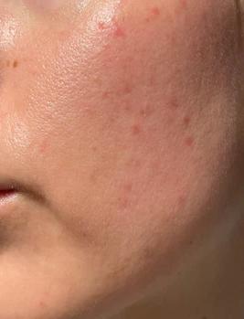 After - Skin Texture