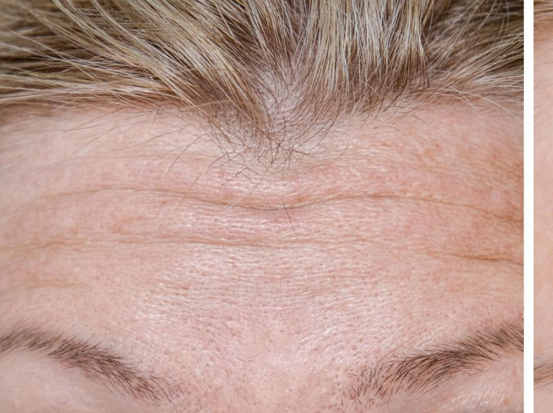 Before - Forehead Lines