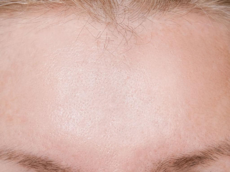 After - Forehead Lines