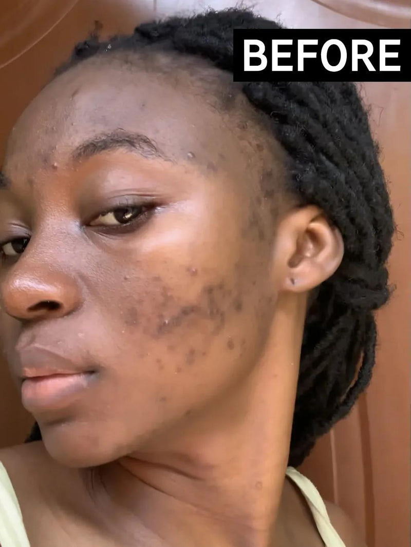 Before - Hyperpigmentation