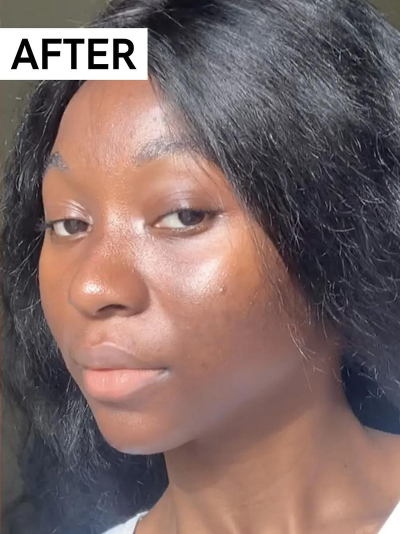 After - Hyperpigmentation