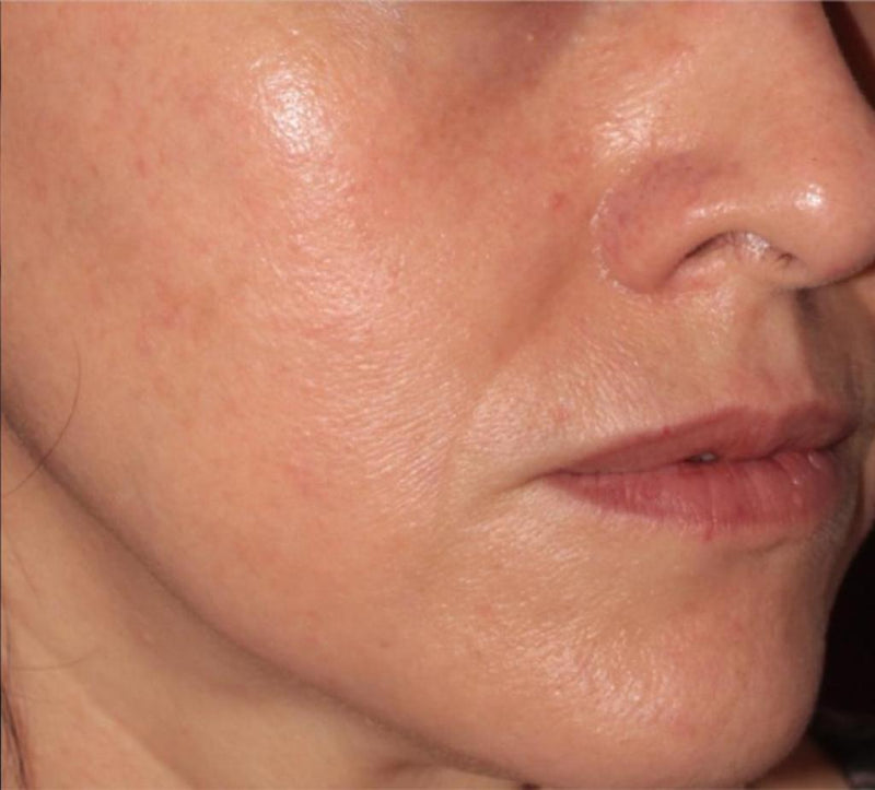 After - Overall Rejuvenation